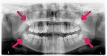 X-ray of teeth showing wisdom teeth needed to be extracted